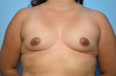 Breast Augmentation Before & After Gallery - Patient 320261 - Image 1