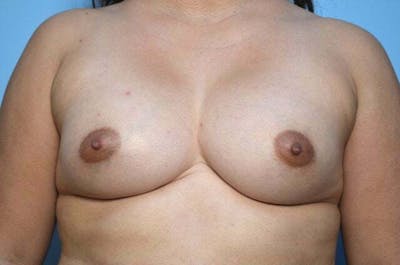 Breast Augmentation Before & After Gallery - Patient 320261 - Image 2