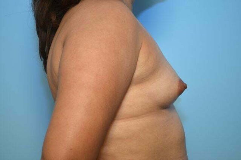 Breast Augmentation Before & After Gallery - Patient 320261 - Image 5
