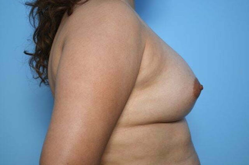 Breast Augmentation Before & After Gallery - Patient 320261 - Image 6