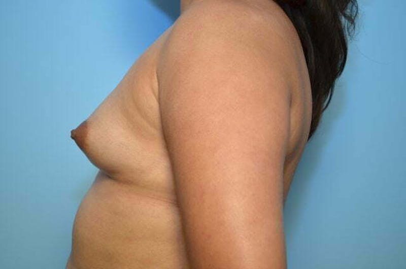 Breast Augmentation Before & After Gallery - Patient 320261 - Image 9