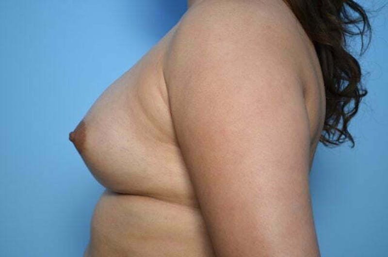 Breast Augmentation Before & After Gallery - Patient 320261 - Image 10