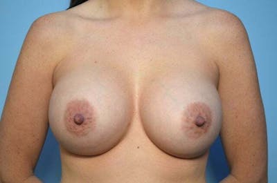 Breast Augmentation Before & After Gallery - Patient 234356 - Image 2