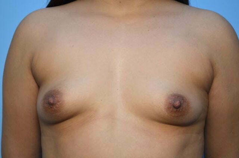 Breast Augmentation Before & After Gallery - Patient 186126 - Image 1