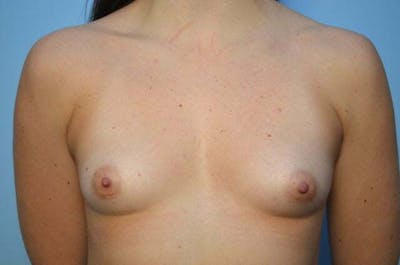 Breast Augmentation Before & After Gallery - Patient 120074 - Image 1