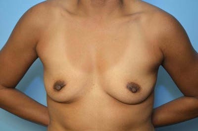 Breast Augmentation Before & After Gallery - Patient 369203 - Image 1