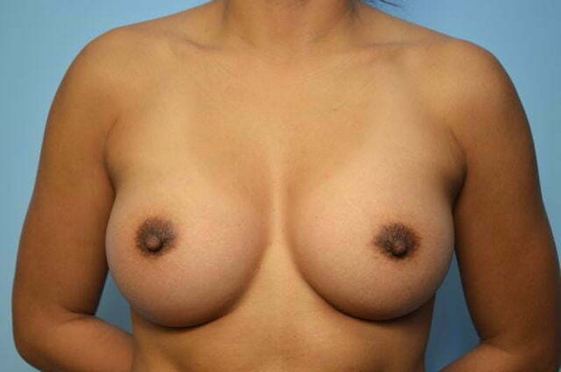Breast Augmentation Before & After Gallery - Patient 369203 - Image 2