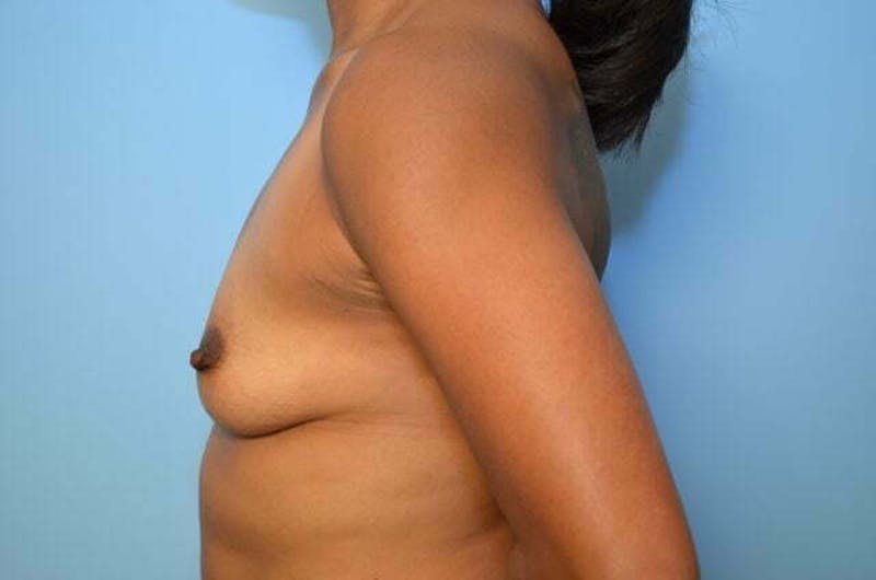 Breast Augmentation Before & After Gallery - Patient 369203 - Image 9