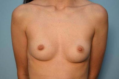 Breast Augmentation Before & After Gallery - Patient 118670 - Image 1