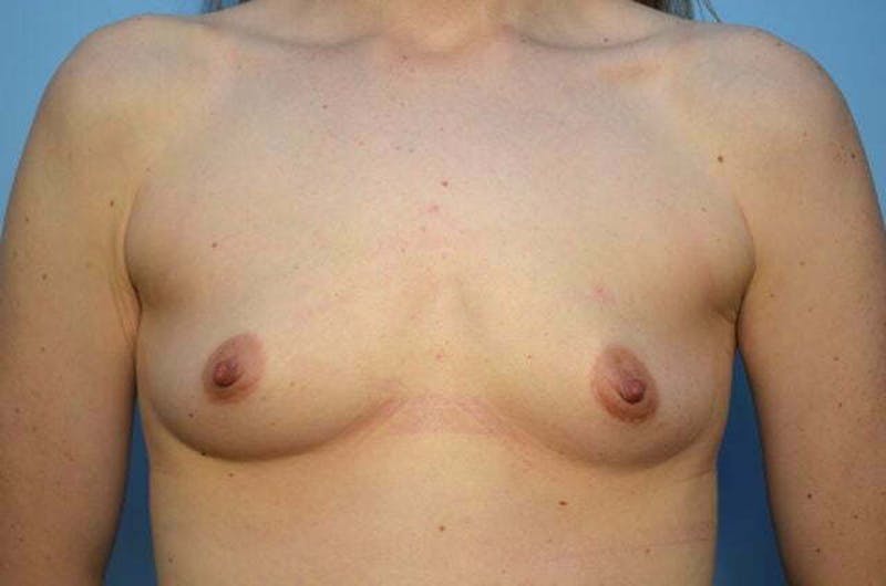 Breast Augmentation Before & After Gallery - Patient 394584 - Image 1
