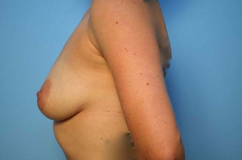 Breast Augmentation Before & After Gallery - Patient 337651 - Image 9