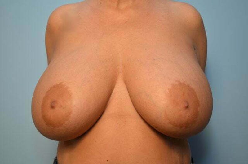 Breast Augmentation Before & After Gallery - Patient 407985 - Image 2