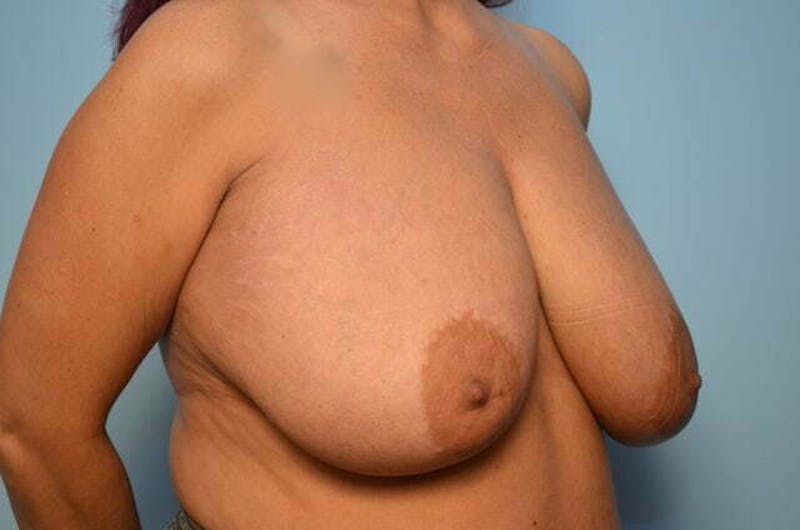 Breast Augmentation Before & After Gallery - Patient 407985 - Image 3