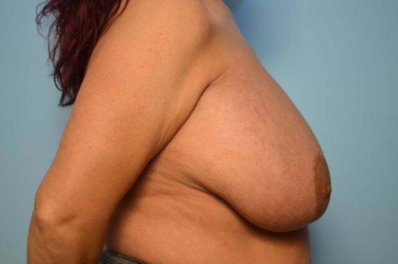 Breast Augmentation Before & After Gallery - Patient 407985 - Image 5