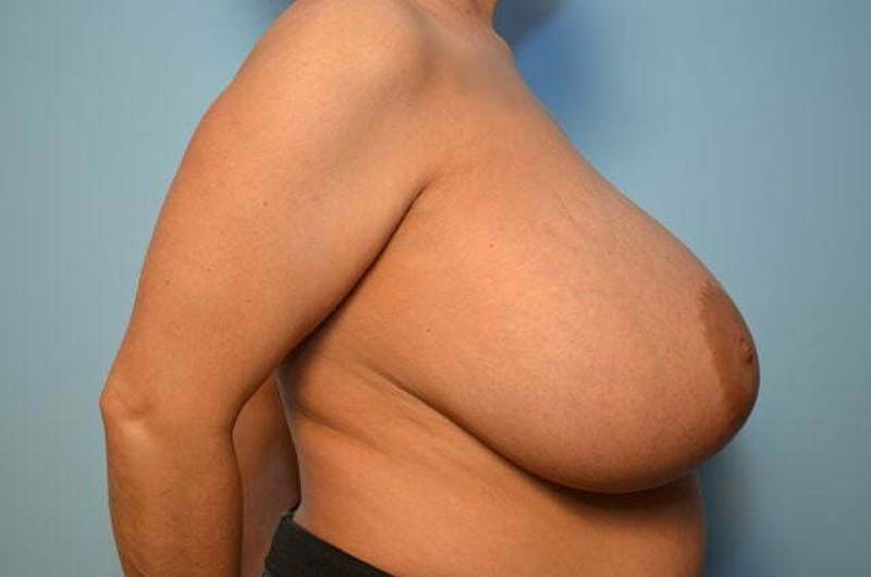 Breast Augmentation Before & After Gallery - Patient 407985 - Image 6