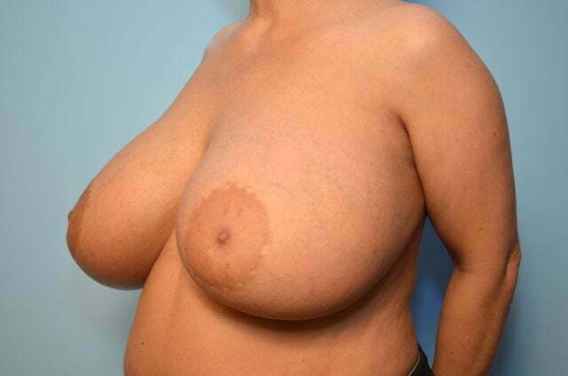 Breast Augmentation Before & After Gallery - Patient 407985 - Image 8