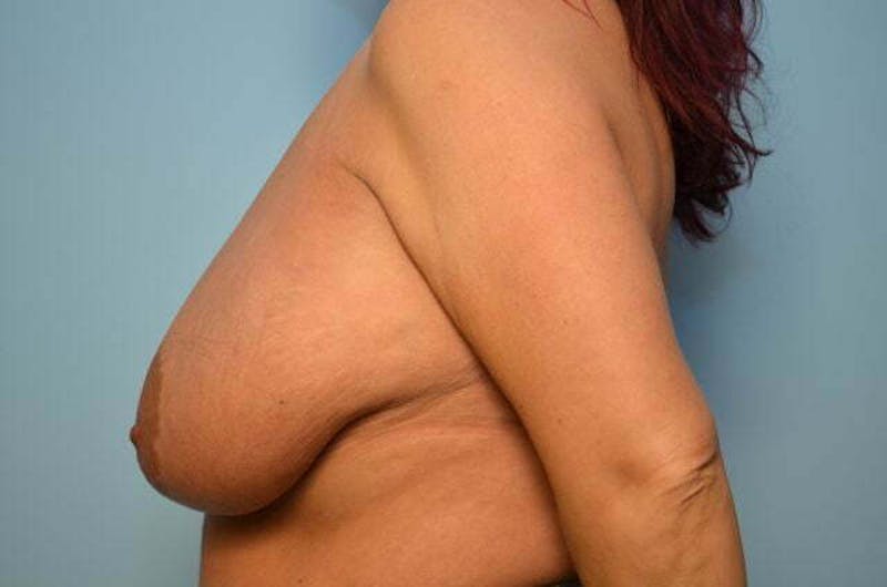 Breast Augmentation Before & After Gallery - Patient 407985 - Image 9