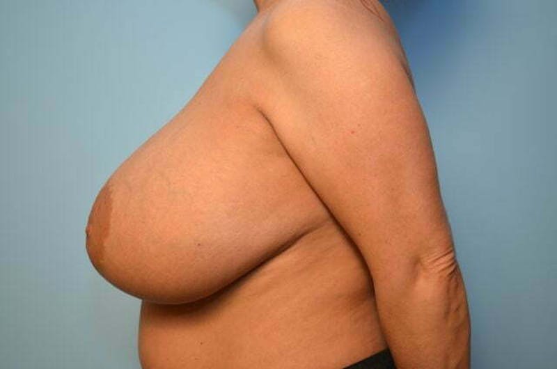 Breast Augmentation Before & After Gallery - Patient 407985 - Image 10