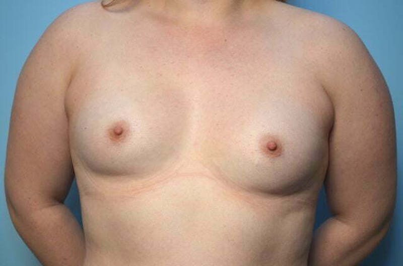 Breast Augmentation Before & After Gallery - Patient 220437 - Image 1