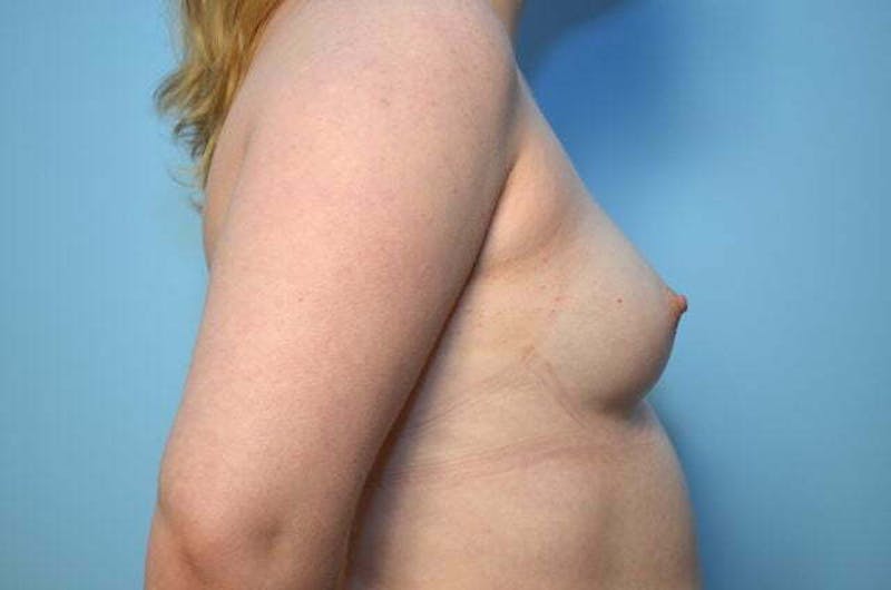 Breast Augmentation Before & After Gallery - Patient 220437 - Image 5