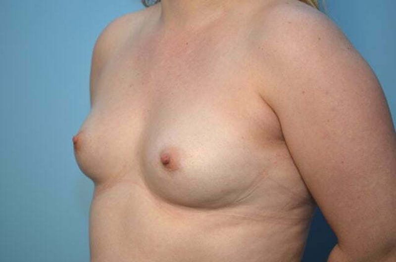 Breast Augmentation Before & After Gallery - Patient 220437 - Image 7