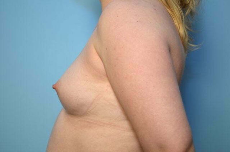 Breast Augmentation Before & After Gallery - Patient 220437 - Image 9