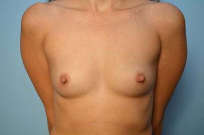 Breast Augmentation Before & After Gallery - Patient 143547 - Image 1