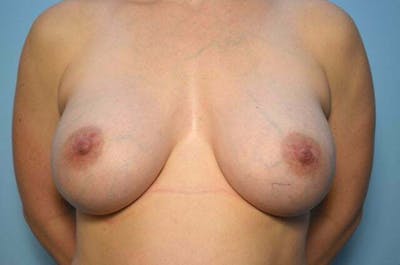 Breast Augmentation Before & After Gallery - Patient 426139 - Image 2