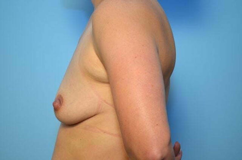 Breast Augmentation Before & After Gallery - Patient 426139 - Image 9