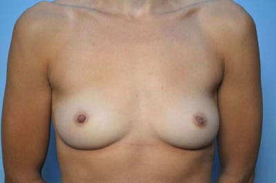 Breast Augmentation Before & After Gallery - Patient 374123 - Image 1