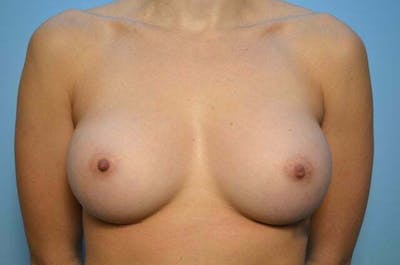 Breast Augmentation Before & After Gallery - Patient 374123 - Image 2