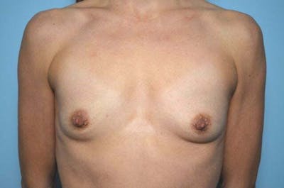 Breast Augmentation Before & After Gallery - Patient 279398 - Image 1