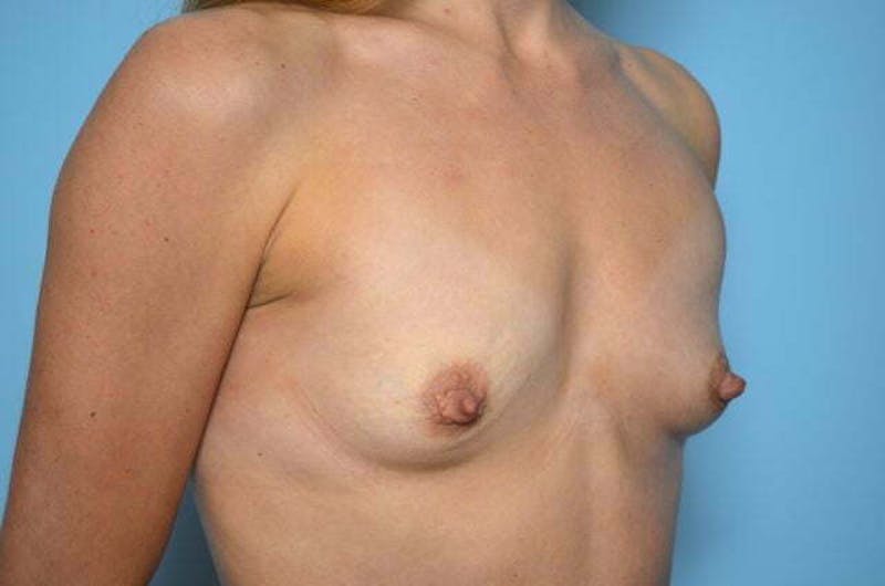 Breast Augmentation Before & After Gallery - Patient 279398 - Image 3