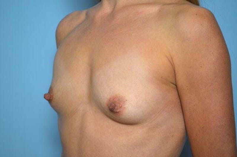 Breast Augmentation Before & After Gallery - Patient 279398 - Image 7