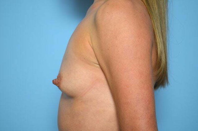 Breast Augmentation Before & After Gallery - Patient 279398 - Image 9