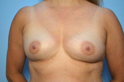 Breast Augmentation Before & After Gallery - Patient 370978 - Image 1