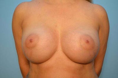 Breast Augmentation Before & After Gallery - Patient 370978 - Image 2