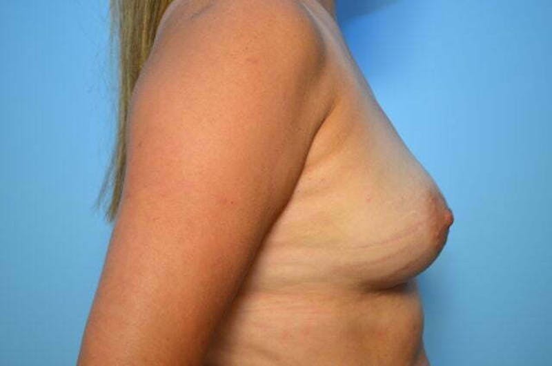 Breast Augmentation Before & After Gallery - Patient 370978 - Image 5