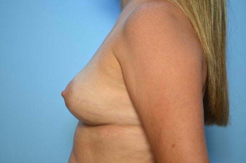 Breast Augmentation Before & After Gallery - Patient 370978 - Image 9
