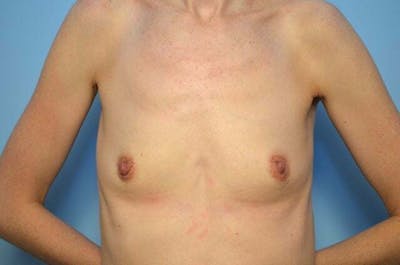 Breast Augmentation Before & After Gallery - Patient 354989 - Image 1