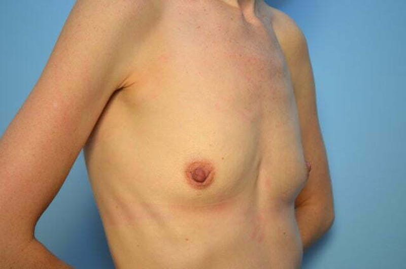 Breast Augmentation Before & After Gallery - Patient 354989 - Image 3