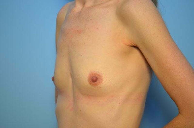 Breast Augmentation Before & After Gallery - Patient 354989 - Image 7