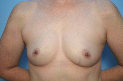 Breast Augmentation Before & After Gallery - Patient 391611 - Image 1