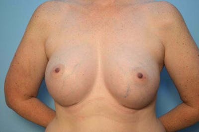 Breast Augmentation Before & After Gallery - Patient 391611 - Image 2