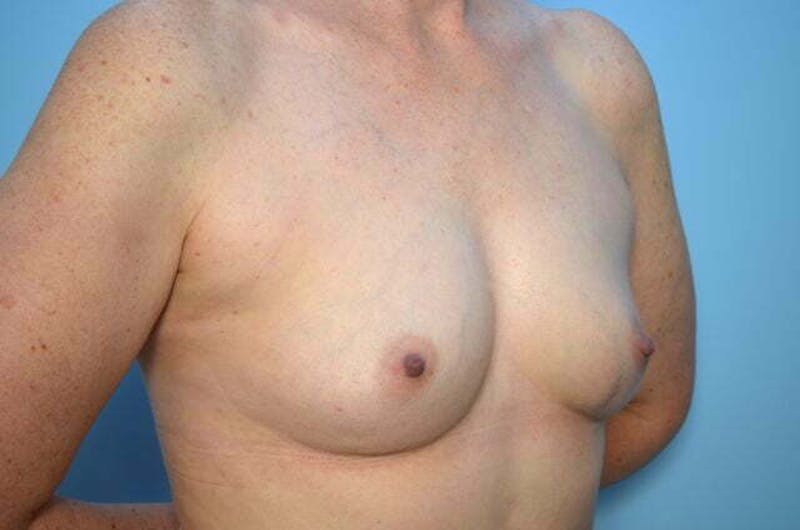 Breast Augmentation Before & After Gallery - Patient 391611 - Image 3