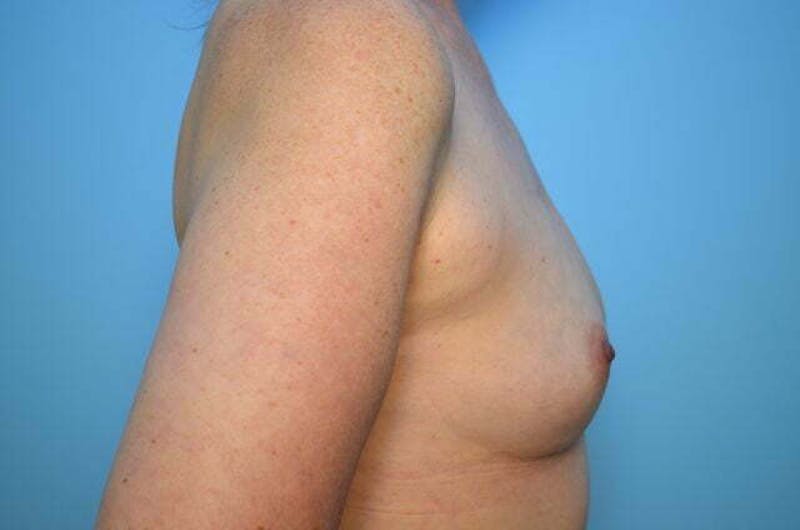 Breast Augmentation Before & After Gallery - Patient 391611 - Image 5