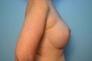 Breast Augmentation Before & After Gallery - Patient 391611 - Image 6