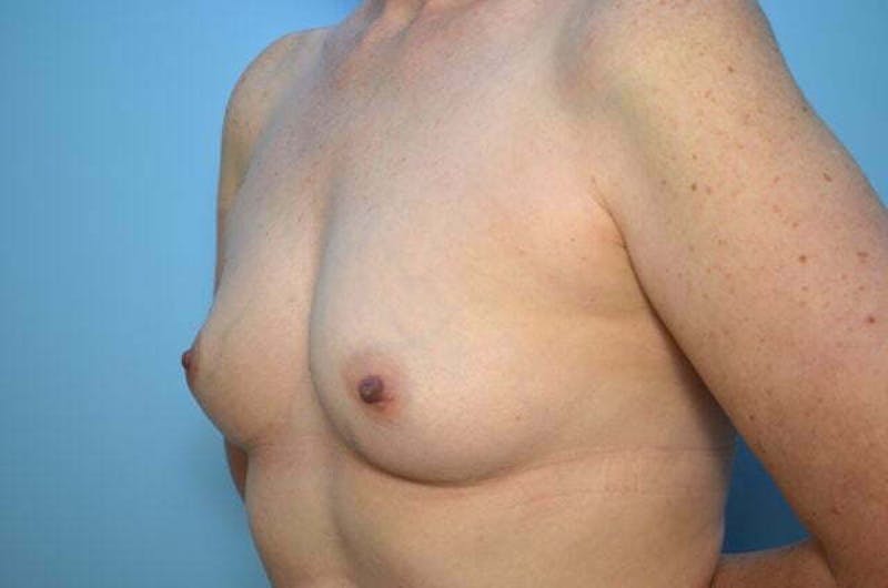 Breast Augmentation Before & After Gallery - Patient 391611 - Image 7