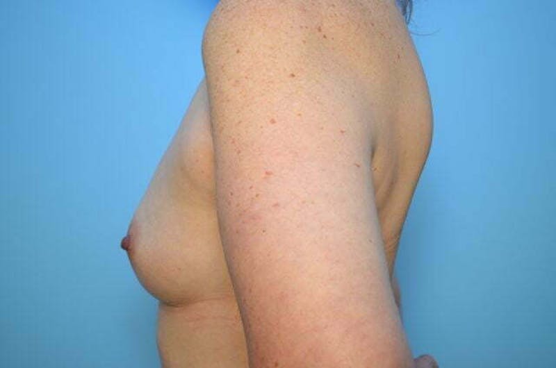 Breast Augmentation Before & After Gallery - Patient 391611 - Image 9
