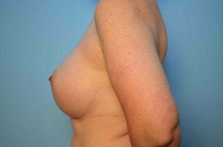 Breast Augmentation Before & After Gallery - Patient 391611 - Image 10